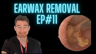 Earwax Removal Ep11  Typical Microsuction Treatment [upl. by Amekahs]