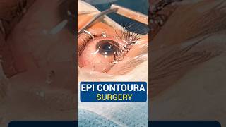 Live EPI Contoura Surgery [upl. by Tedie701]