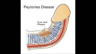 Peyronies Disease by Biomedic Labs Rx [upl. by Undry652]