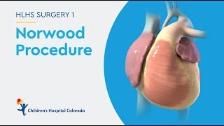 What is the Norwood Procedure for Hypoplastic Left Heart Syndrome [upl. by Querida]