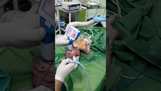 Newborn intubation using UE Miller 0 blade [upl. by Dom125]