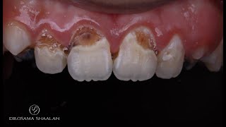 Simplified anterior composite restorations [upl. by Atlanta572]