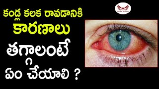 కండ్ల కలక తగ్గాలంటే  Conjunctivitis  Kalla Kalaka  Eagle Health [upl. by Post]