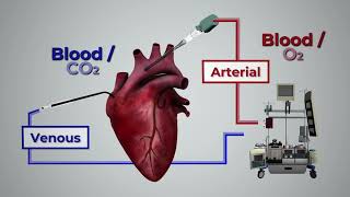 Circulación Extracorpórea ECMO [upl. by Aurel]