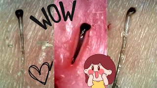 Super Satisfying HAIR FOLLICLE PLUCKS Root Removal Under the Microscope [upl. by Zealand290]