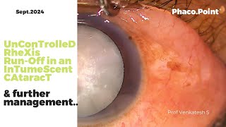 Uncontrolled Rhexis RunOff in an Intumescent Cataract and Further management with an EDOF IOL [upl. by Adnalram96]