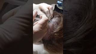 MicronJet™ in Action Intradermal Delivery of PRP to the Scalp Area Dr Elisabeth Dancey [upl. by Deerc]