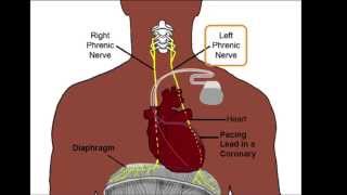 Left Phrenic Nerve Anatomy Relative to the Coronary Venous System [upl. by Wsan]