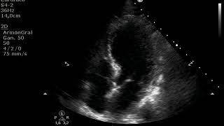 Ecocardiograma Caso Takotsubo Basal [upl. by Miza]