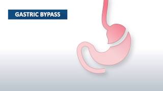 What is gastric bypass surgery  Beaumont Health [upl. by Strader]