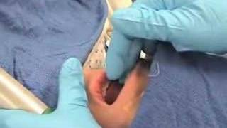 IntubationHow to perform endotracheal intubation  2 [upl. by Araid]