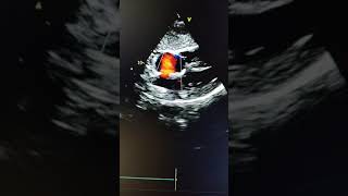 Ostium Secundum OS  ASD in subcostal view in echocardiography [upl. by Aihseyk8]