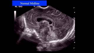 Neonatal Neurosonography The Premature Infant [upl. by Vikky]