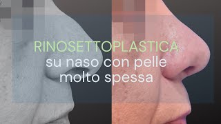 Caso di Rinosettoplastica su naso con pelle molto spessa [upl. by Hamehseer]