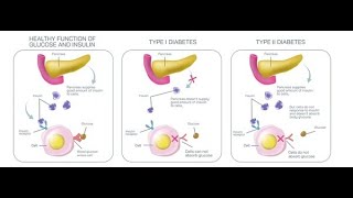 Differences between the Clinical features of Diabetes mellitus Type 1 and Type 2 [upl. by Aerdnek]