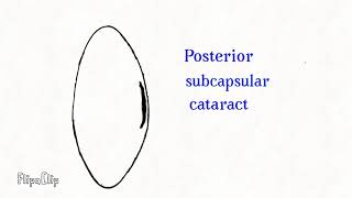 Morphological classification of Cataract  Lens [upl. by Adon]