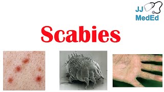 Scabies Skin Condition  What Is It Classic vs Crusted Types Signs amp Symptoms Treatment [upl. by Leticia]