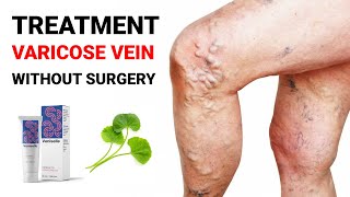 Best Medicine for Varicose vein 2023  Varicose vein Treatment without Surgery [upl. by Simonsen790]