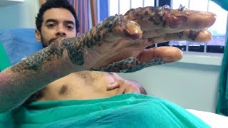 Can tilapia skin be used to bandage burns [upl. by Weldon]