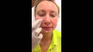 Mirvaso treatment for facial redness caused by rosacea [upl. by Wade]