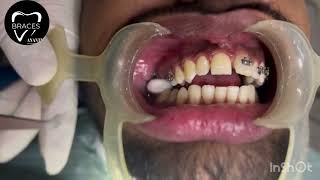 CLASS 2 DIV 1  BRACES  ORTHODONTICS  ANANTNAG trending braces dentist imrankhan [upl. by Eitisahc]