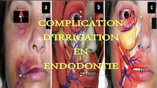 Complications dirrigation à lhypochlorite de sodium en endodontie [upl. by Amzaj]