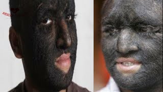 HYPERTRICHOSIS RARE but TRUE What is the Cause Find out why [upl. by Bryner]