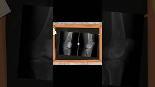 Imaging in Ewing Sarcoma ewingsarcoma ewing sarcoma ortholectures orthopaedics [upl. by Jonathan]