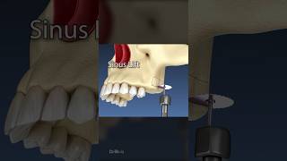 Sinus Lift Surgery 3D Animation [upl. by Nolahc]