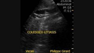 Vscan Coledocolitiasis con barro biliar [upl. by Arenahs402]