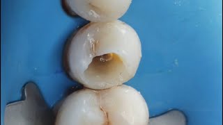 Demonstration of PreEndodontic Build up [upl. by Enelyar]