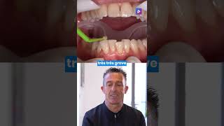 Orthodontie lingual et vestibulaire  collage en technique mixte 🦷 [upl. by Ridley408]