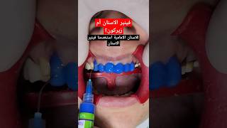 فينير الأسنان ام تلبيسات زيركون؟  Veneers vs Zirconia [upl. by Olnee]