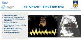 Fetal Heart Examination [upl. by Jacobba]