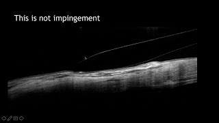 Anterior Segment amp Contact Lens Applications of OCT [upl. by Ilek668]