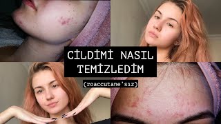 SİVİLCELERİMDEN NASIL KURTULDUM ✨ roaccutane’sız [upl. by Ticon]