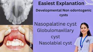 Developmental Non Odontogenic cysts Oral Pathology BDS Nasopalatine Globulomaxillary Nasolabial [upl. by Potts]