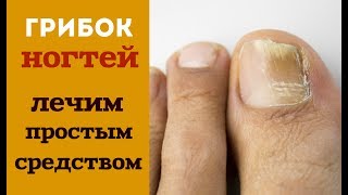 КАК ЛЕЧИТЬ ГРИБОК НОГТЕЙ ПРОСТОЙ И ЭФФЕКТИВНЫЙ МЕТОД ЛЕЧЕНИЯ [upl. by Cirderf]