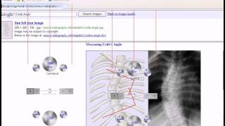 Cobb Angle Measurement [upl. by Ahsikat81]