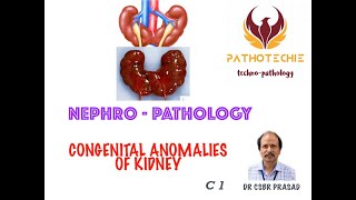 Congenital Anomalies of Kidney [upl. by Assenar]