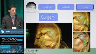 Dr Adam B Yanke Talks about Medial Patellofemoral Ligament MPFL [upl. by Corrine506]