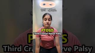 😭🥺 PTOSIS  Oculomotor nerve 3rd cranial nerve palsies Dropping of the eyelid  physiotherapy [upl. by Decima]