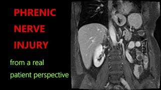 PHRENIC NERVE INJURY PARALYZED DIAPHRAGM SYMPTOMS TREATMENTS MedEd MedTwitter [upl. by Hoo135]