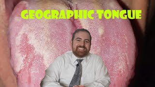 Geographic Tongue A Clinical Review [upl. by Jaclyn]