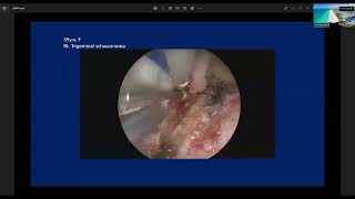 Endoscopic Kayhole Anterior Petrosal Approach to Petrous Lesions  Professor Takeo Goto [upl. by Freberg]