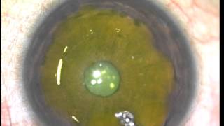 Intacs CXL C3R for Keratoconus Soosan Jacob [upl. by Eydie]