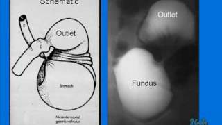 Gastric Volvulus in a Newborn [upl. by Isolda]