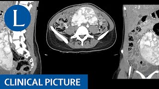 A wandering spleen splenomegaly hypersplenism and iron deficiency anaemia [upl. by Robison585]