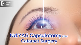 NdYAG Capsulotomy after Cataract Surgery All about ProcedureDrSriram Ramalingam Doctors Circle [upl. by Vanna520]