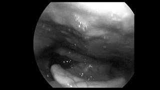 Video laryngoscopy showing Intra Epithelial Cell Carcinoma of Larynx [upl. by Mauri]